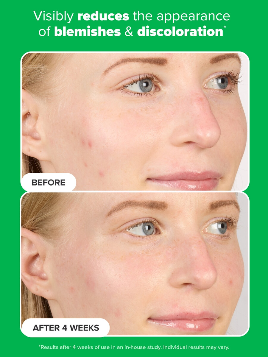 azelaic acid booster