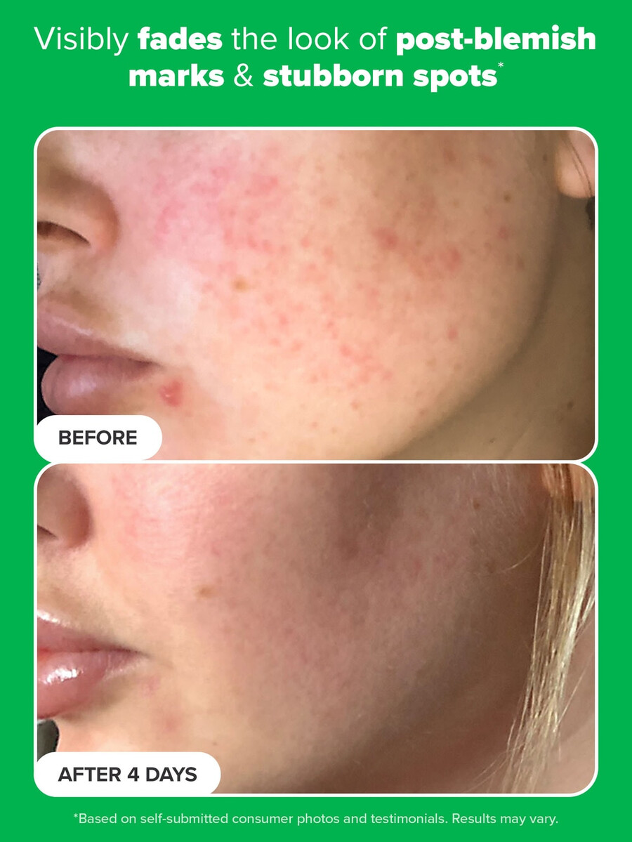 azelaic acid booster