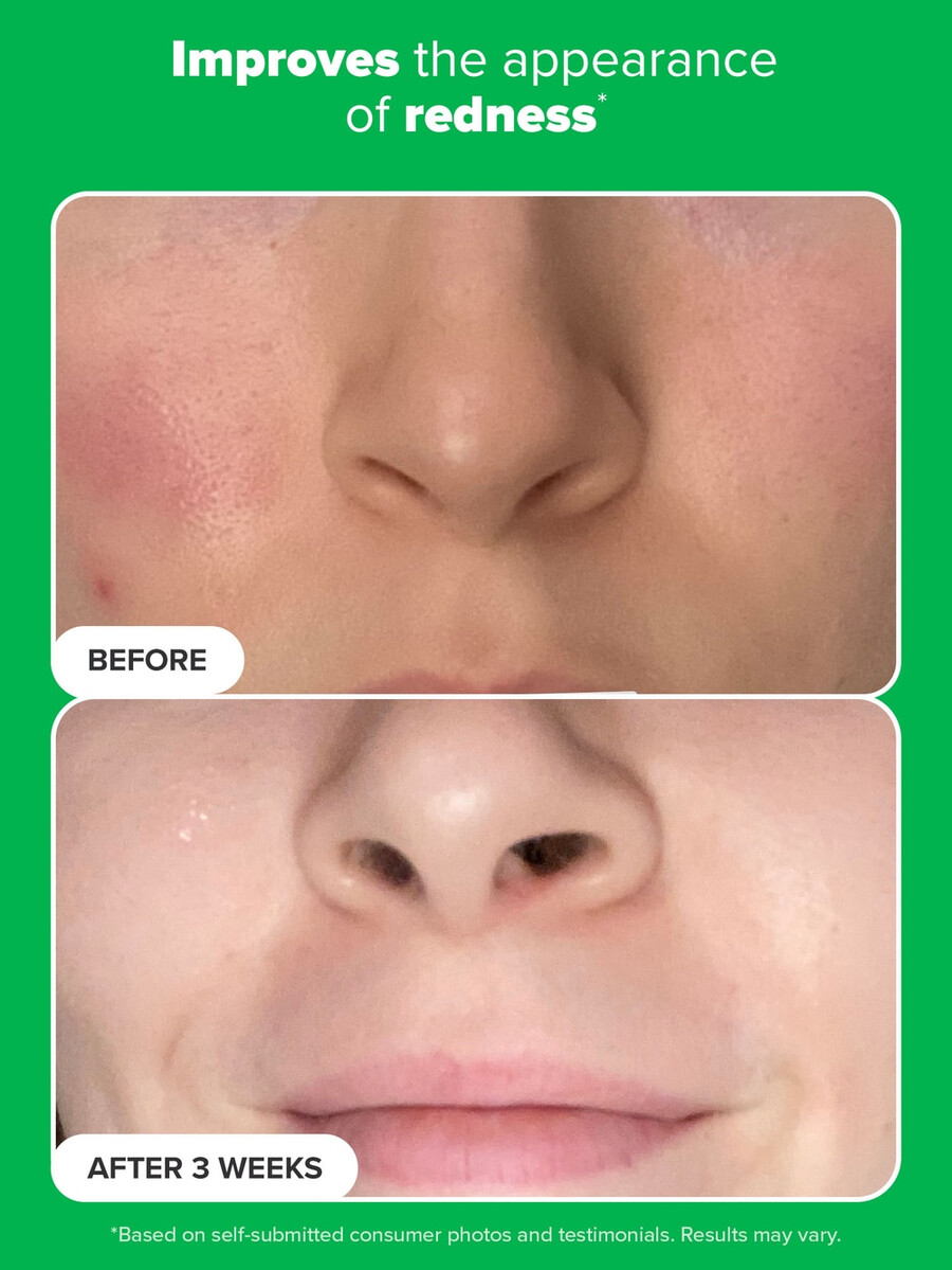 azelaic acid booster